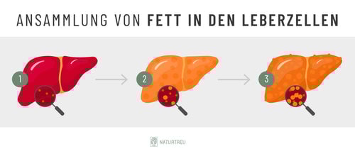 Ansammlung von Fett in den Leberzellen Darstellung einer von zu viel Fett belasteten Leber